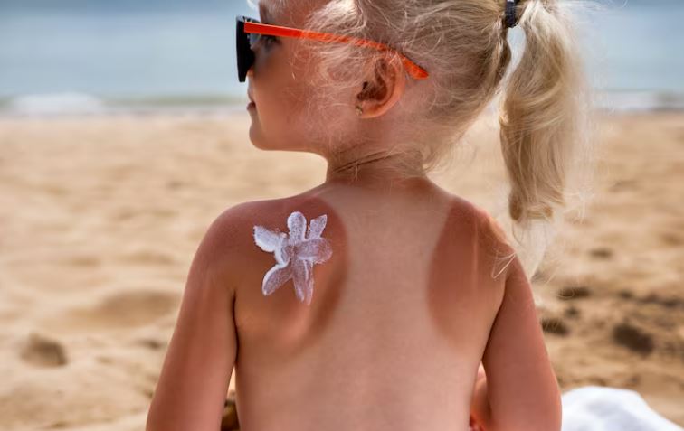 Menina loira de costas, na praia, com uma forte queimadura de sol nos ombros (linhas brancas de biquíni e óculos de sol) e protetor solar aplicado em formato de flor no ombro esquerdo.